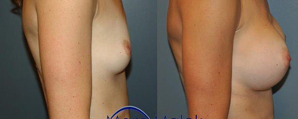 Breast Augmentation With Silicone Before and After breastau
