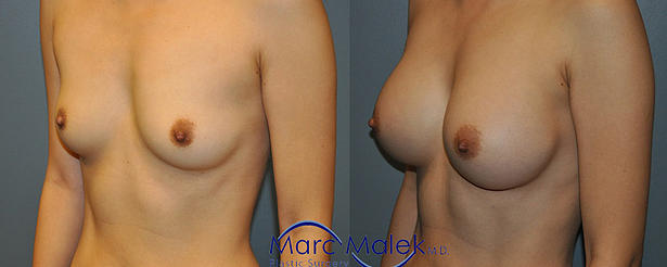 Breast Augmentation With Silicone Before and After breastau