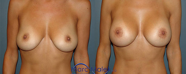 Breast Augmentation With Silicone Before and After breastau