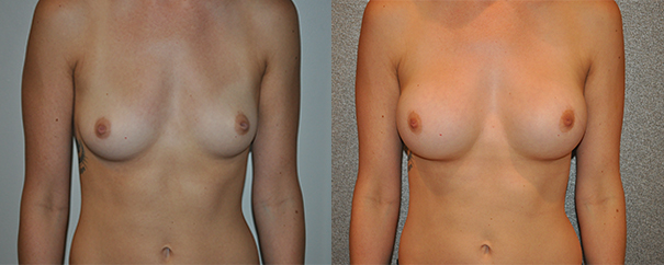 Breast Augmentation With Silicone Before and After breastau