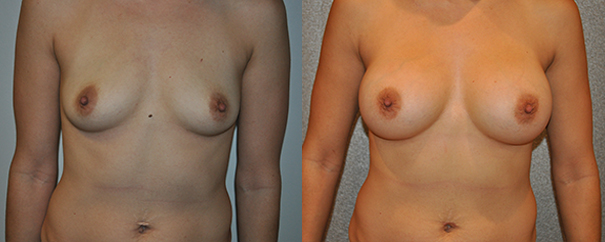 Breast Augmentation With Silicone Before and After breastau